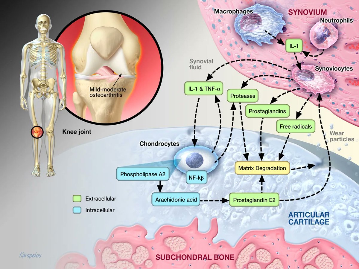 #Medical #illustration by John Karapelou depicting the roles of catabolic factors in the development of #osteoarthritis.

Explore more by John: buff.ly/3rl6koF 

#medicalillustration #3D #endocrinology #cellbiology #medicalillustrator #biomedicalart #medicalart #sciart