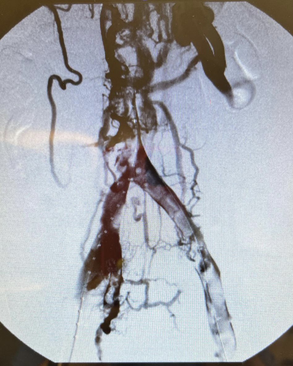 Guerravascular's tweet photo. Hoy primer caso de EKOS en @Hospital Universitario de Guadalajara
Paciente con Agenesia de Cava suprarrenal y Trombosis de Cava Infrarrenal e Iliacas
Angiología y Cirugía Vascular
Seguimos avanzando en #castillalamancha https://t.co/usCDDWUvJM