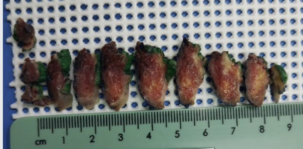 #grosspath  #BSTPath 
Very interesting case let's play the #grossognosis
9 years old with an 8 cm paraspinal  mass 
What are your favored diagnoses?
I will share micro pics at some point this week  😆