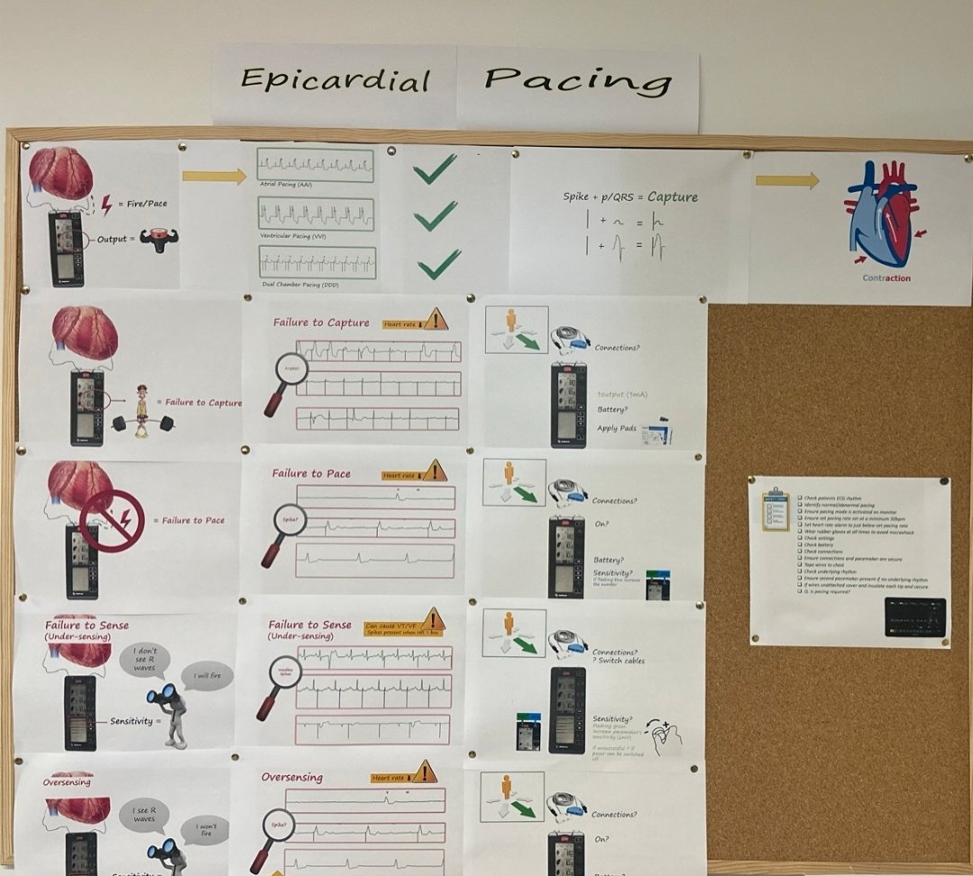 Epicardial pacing education board for July in Keith Shaw Cardiac ICU. A creative & informative way to update staff and refresh knowledge #SJHNursing #criticalcare #nurseeducation @stjamesdublin