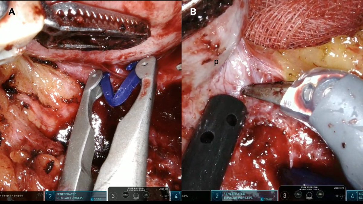 RicBertolo's tweet photo. #Enucleation vs #Enucleoresection
Work in progress preparing the @urovidjournal special issue on #Robotic #PartialNephrectomy featured by the @EAUYAU_RenalCa.
๐ฉDM me if you would like to publish a nice video on the #management of #complications. https://t.co/twmuFABTNv