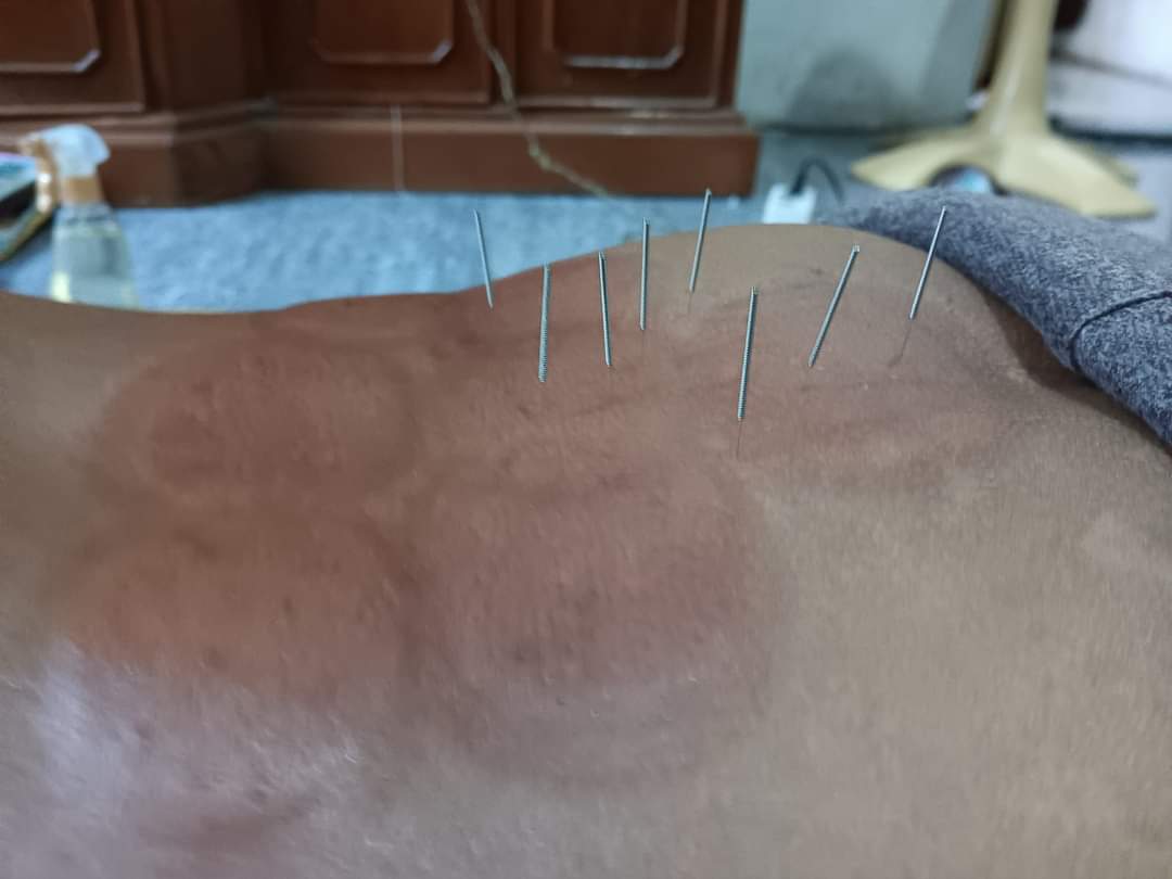Akupuntur pengobatan kuno tetap keren di masa modrn 👍