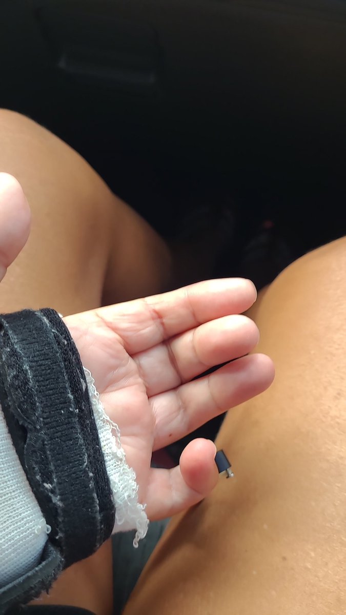 Juliethewarrior's tweet photo. #DigitWidget how y'all feel I can tweet about this and reply. This device is straightening my joints from contractures from have #Scleroderma. It's been a month since having surgery to try to correct. I waited until I was losing hand function to have surgery. It's miraculous. https://t.co/MsUfLaolfe