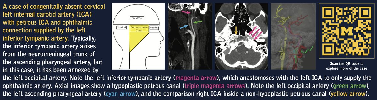 Abstract accepted to RSNA 2023: "Highways to the Danger Zone: Craniofacial to Cerebrovascular Anastomoses." Here is a sneak peek at one of the cases from the piece. Scan the QR code and check out the model.  <a href="/LinYuanci/">Leanne Yuanci Lin</a> <a href="/ZWilseckMD/">Zachary Wilseck</a> <a href="/bourgeoisree/">Sreehari Panicker</a> <a href="/NIR_ChaudharyMD/">Neeraj Chaudhary</a> <a href="/joeyg132513/">joseph gemmete</a>