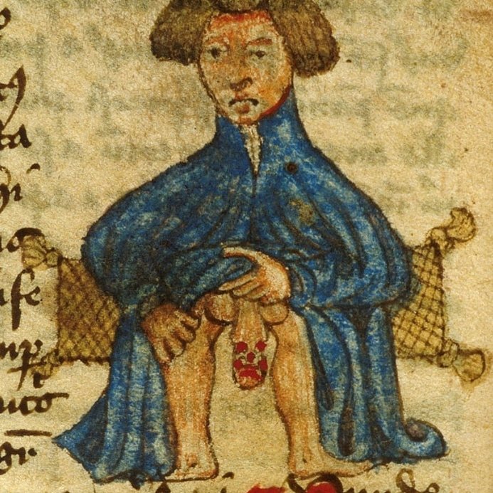 Mal en point, #maladie vénérienne expliquée dans un #traité de #médecine
John Arderne, Liber Medicinarum,  #XVe 
British Library, Sloane 56, fol. 85v

#penis #naked #venerealdisease #15thcentury #Medieval #medicine #manuscript