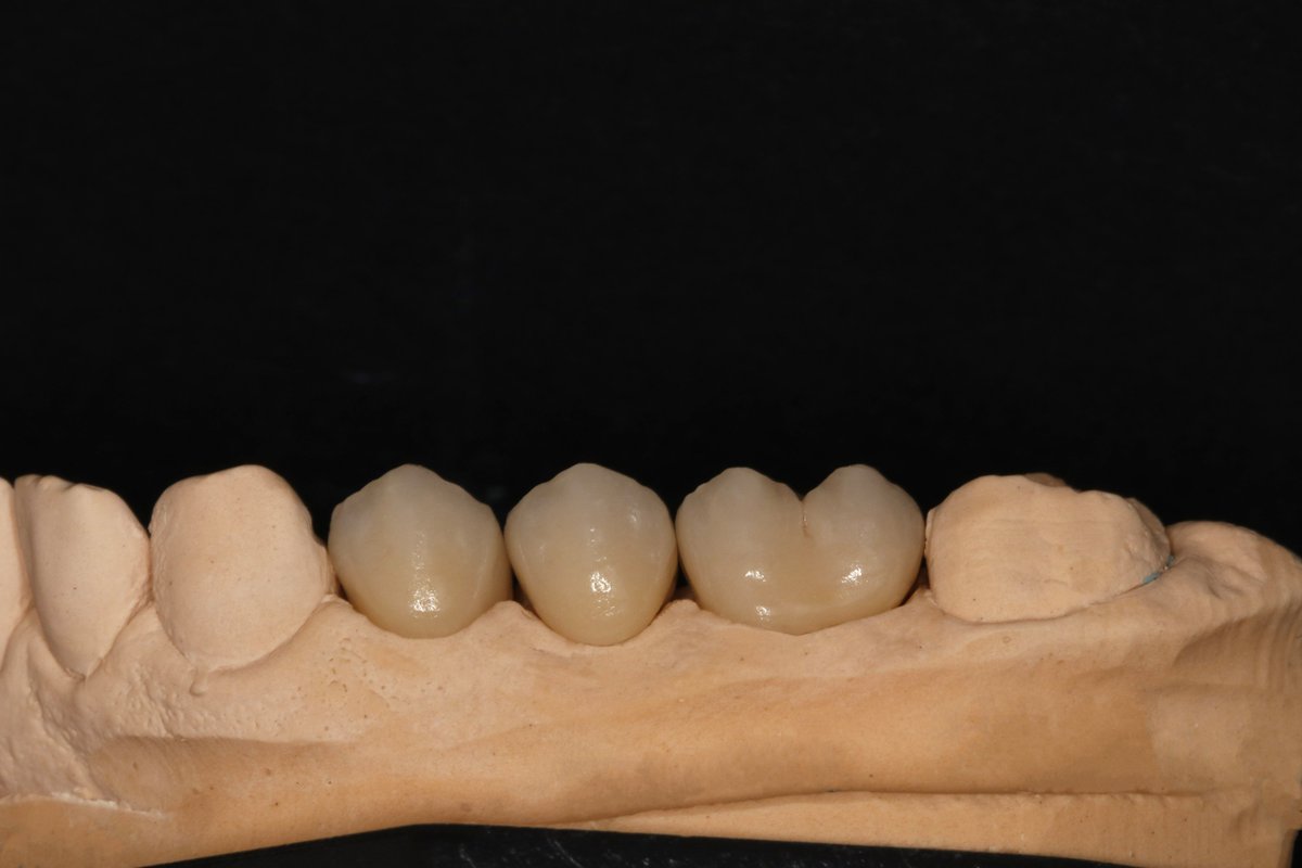 In Alpha. We try to simulate the natural shape of the posterior teeth, considering the functional aspect of those teeth.