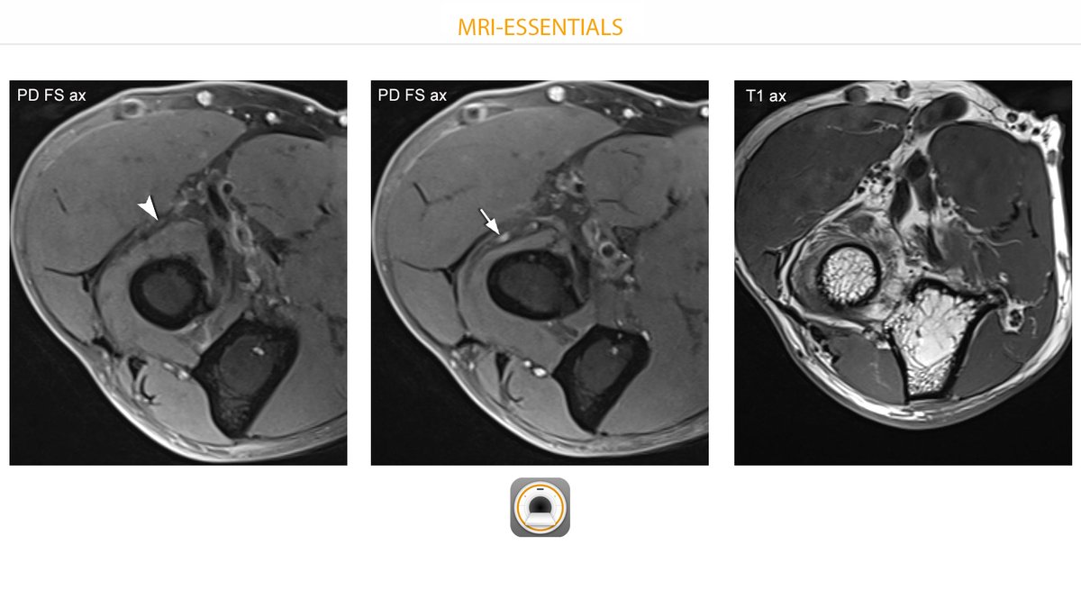 EssentialsMri's tweet photo. Radial tunnel syndrome. Note the atrophy of the supinator muscle in T1. The deep branch of the radial nerve is unremarkable before entering the supinator (arrowhead) and shows neuritis slightly more distally (arrow).
#mskrad #orthotwitter #radres #radiology https://t.co/TryvbeHTO1