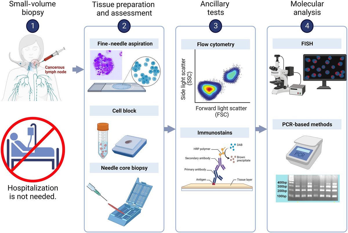 CancerCytopath's tweet image. Read this new commentary by @twmarkc on practical issues of small-volume biopsy of follicular lymphoma: acsjournals.onlinelibrary.wiley.com/doi/full/10.10…

@mdlozanoe @MozeticV @SamKhader @barkanga @EfcsYoung @aakasharmand @sza_jhcyto #cytopath #fnapath #hematology #lymphoma