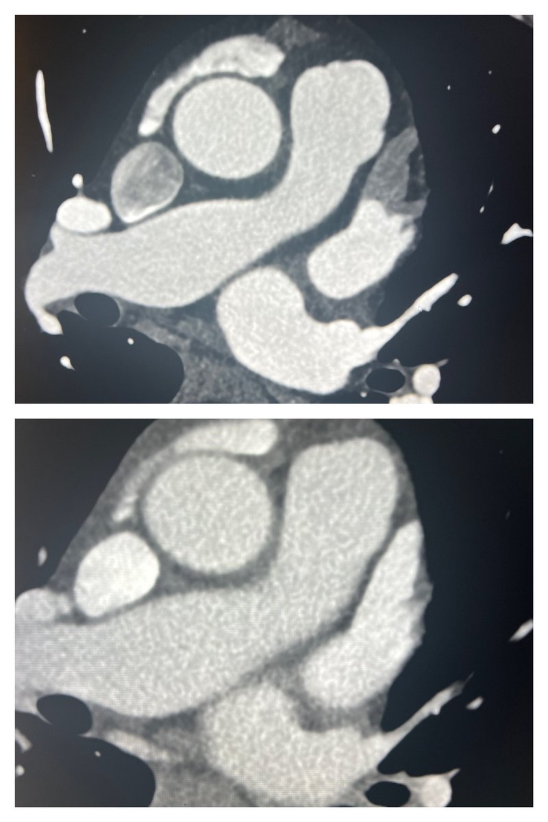 Usefulness of delayed phase acquisition (bottom) for exclusion of left atrial appendage tip thrombus on LAA and Pulm Vein studies.  Arterial phase (top) w incomplete opacification and pseudothrombus.