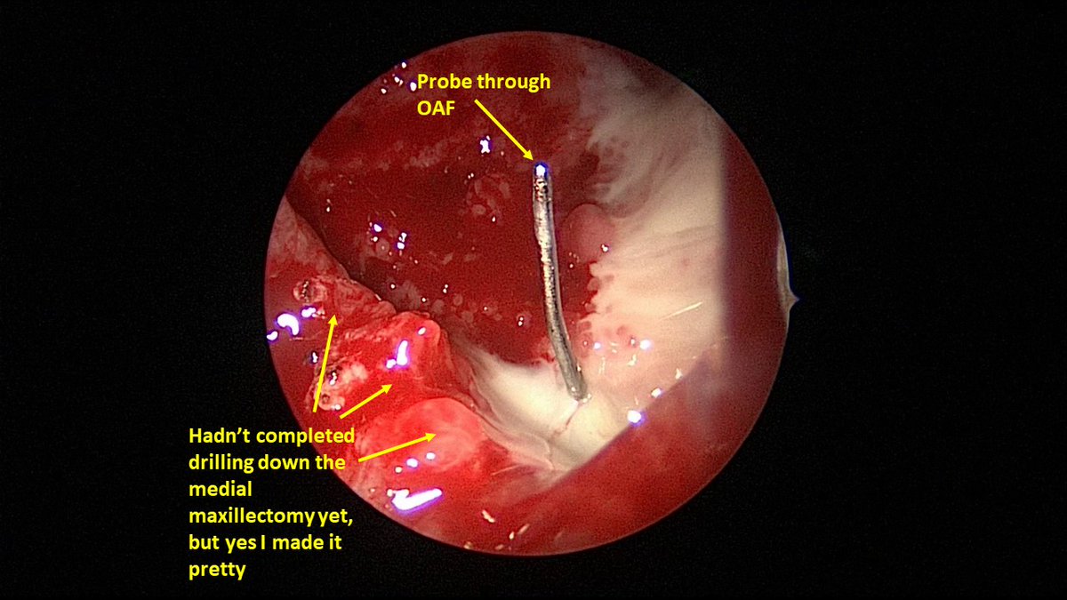 John Craig, MD (@johncraignose) on Twitter photo Even if you're annoyed by repeated #ODS posts, come on, this disease produces cool images. #Papillaryedema in setting left maxillary ODS from OAF. It's not 100% specific to #ODS, but it's very suspicious! Watch for it! <a href="/henryfordent/">Henry Ford ENT</a> #medtwitter Even if you're annoyed by repeated #ODS posts, come on, this disease produces cool images. #Papillaryedema in setting left maxillary ODS from OAF. It's not 100% specific to #ODS, but it's very suspicious! Watch for it! <a href="/henryfordent/">Henry Ford ENT</a> #medtwitter