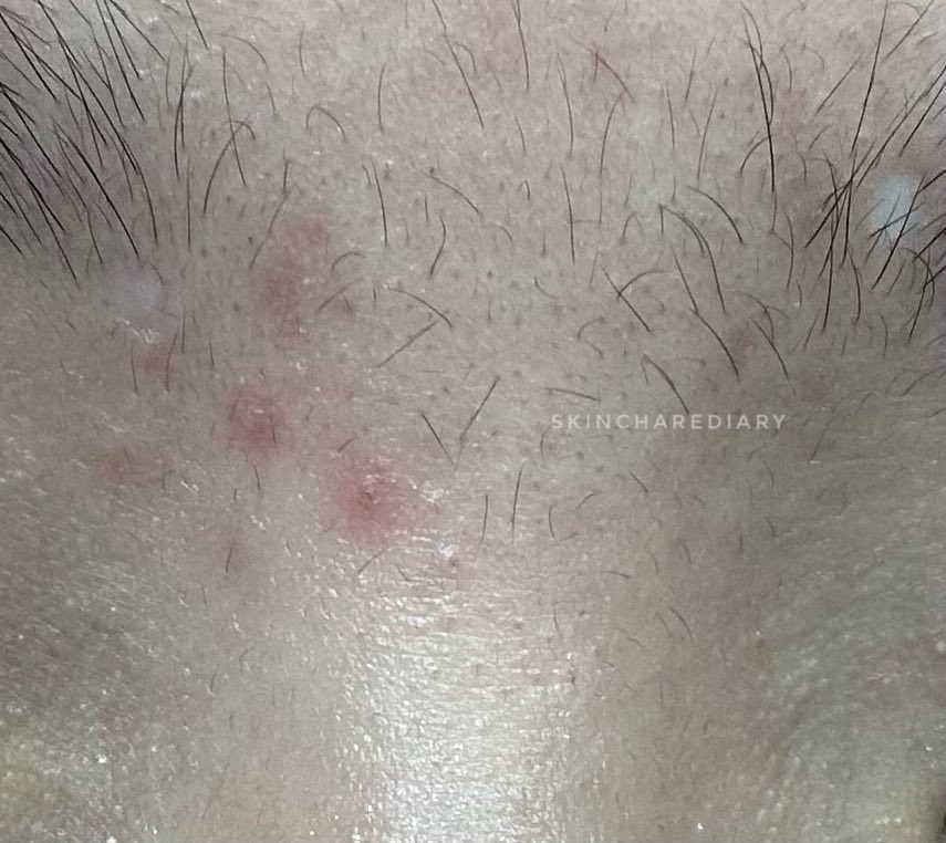 masih edisi berperang melawan breakout sisa2 liburan 🥲☝🏻

emg blm sepenuhnya ilang, tapi udh lumayan mendingan ga sih? kalian bisa simak thread aku kalo lg struggling sm breakout jg! 

btw sori lighting fotonya beda :”)

from this                                  to this