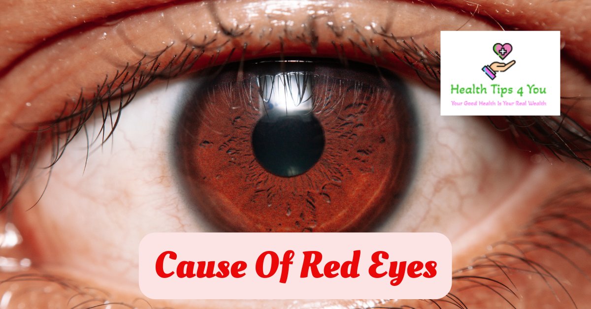 Cause Of Red Eyes:  It's A Pandemic Like Covid-19?
healthtips4you.com/cause-of-red-e…
#howtogetrid #eyeredness #eyeallergies