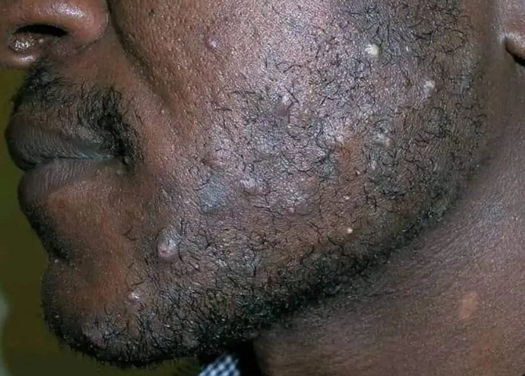 Mosesmunyi5's tweet photo. DUE TO PUBLIC DEMAND LET'S TALK ABOUT PSEUDOFOLLICULITIS BARBAE (PFB) ALSO KNOWN AS SHAVING BUMPS

In this thread 🧵 👇 I will be explaining the cause, predisposing factors, and the best treatment https://t.co/EYEEc1QgOb