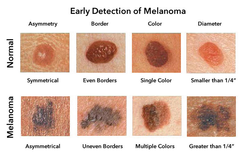 thecybersurg's tweet image. I have treated over 15 melanomas and pre-melanomas this month. I typically average 2 to 4 melanomas a month. What is going on? Melanoma is the leading cause of skin cancer deaths worldwide. this is a very dangerous cancer that can affect everyone from someone in their 20s all the…