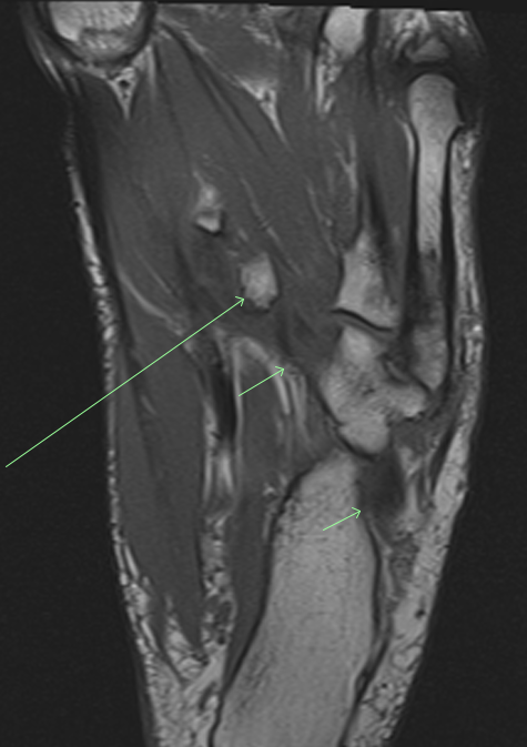 MSKfellowship's tweet photo. 49 yo F with left midfoot pain.

Cor (long-axis) T1 and PD fat sat.

Chronic peroneus longus tendon avulsion fracture fragment (long arrows) from the base of the 1st MT. 

Note the thickened and wavy distal peroneus longus 
tendon (short arrows).

#FOAMed #FOAMrad #MSKrad https://t.co/LEP5nu0v4V