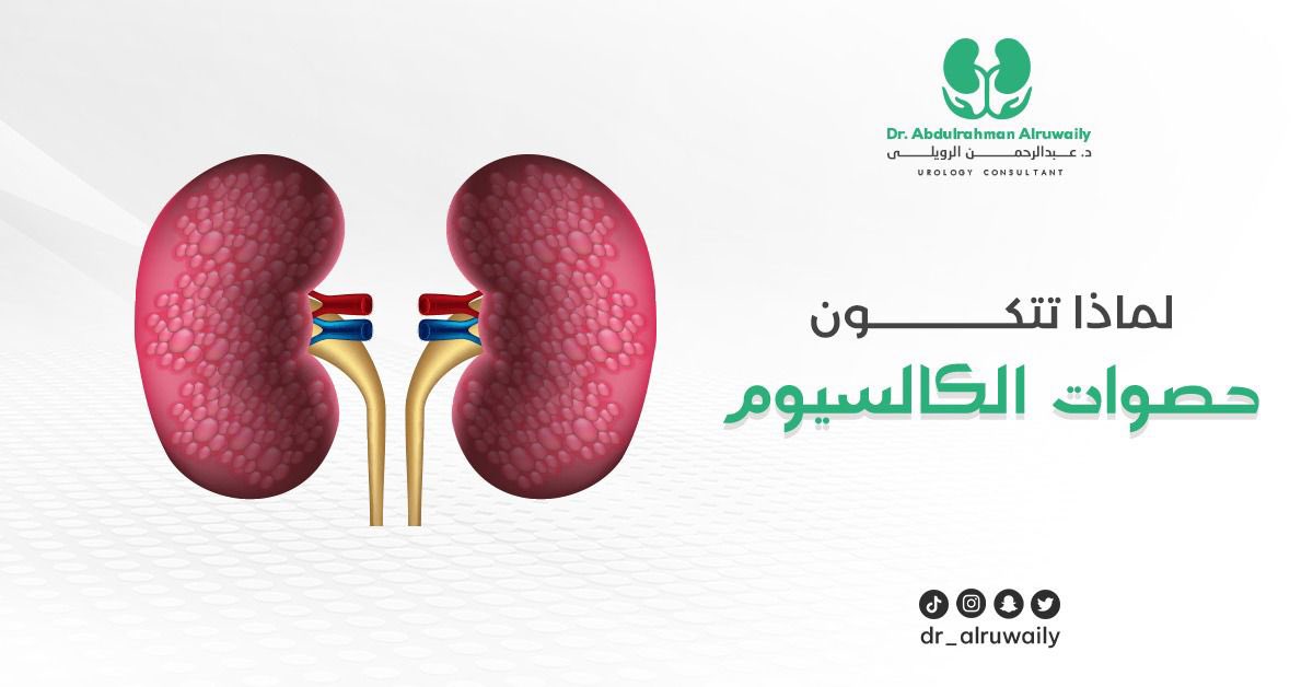 dr_alruwaily's tweet photo. "تتكون حصوات الكالسيوم بشكل رئيسي عند تراكم الكالسيوم في الجسم، لإحدى الأسباب التالية

- فرط نشاط الغدة الجار درقية 
- تناول مكملات الكالسيوم أو فيتامين د دون وجود نقص فيهما 
- جفاف الجسم الشديد
- عوامل وراثية أو جينية 
- بعض الأدوية ومنها أدوية الاضطرابات النفسية ( لعلاج ثنائي القطب)
- قلة النشاط البدني "

د.#عبدالرحمن_الرويلي 
استشاري جراحة الكلى والمسالك 

#مسالك #مسالك_بولية #حصوات_الكلى #حصوات #سرطان_المثانه #اكسبلور #تفاعل #explore #trend #like