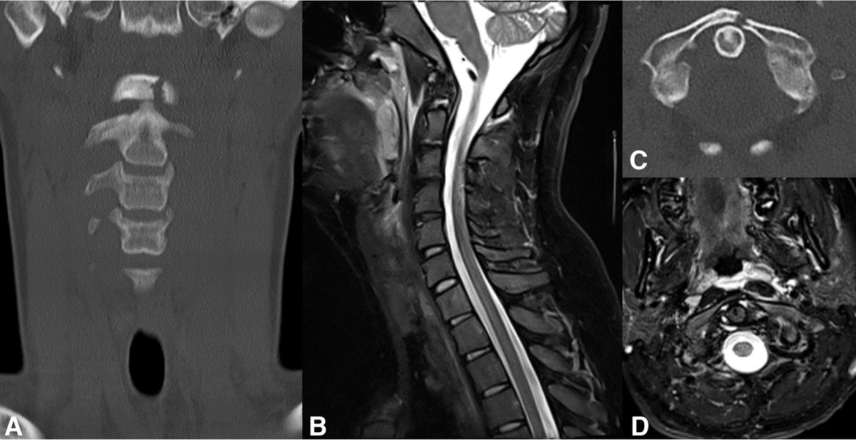 From the April-June 2023 Issue of #Neurographics: Imaging of Blunt Cervical Spine Ligamentous Injuries: Bridging the Gap between Neuroradiologists and Neurosurgeons ow.ly/ubHS50Pfk4K