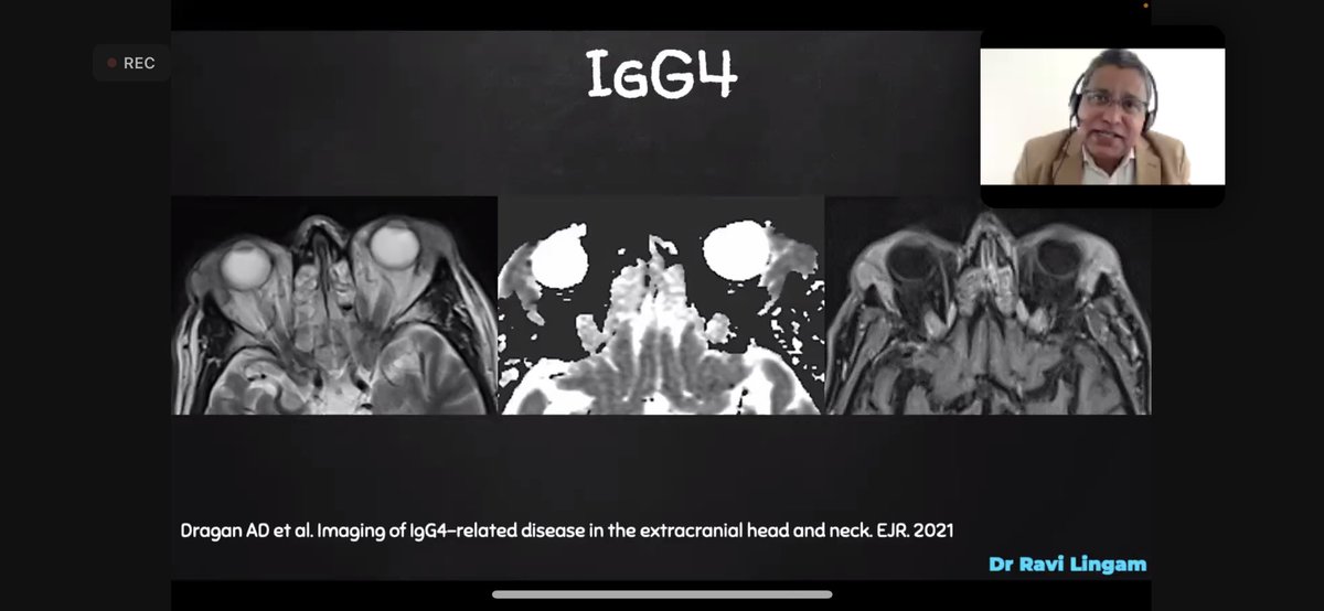 ESHNRSociety's tweet photo. Bilateral lacrimal gland enlargement:
- sarcoidosis
- lymphoma
- IgG4
👉ADC / Diffusion!!!
@YPekcevik @AnnePeporte @jussihirvonen @SalmanQureshiDr @vassallo_edith @davidefarinabs #eshnr #headandneckimaging https://t.co/Rgq1dFJUCr