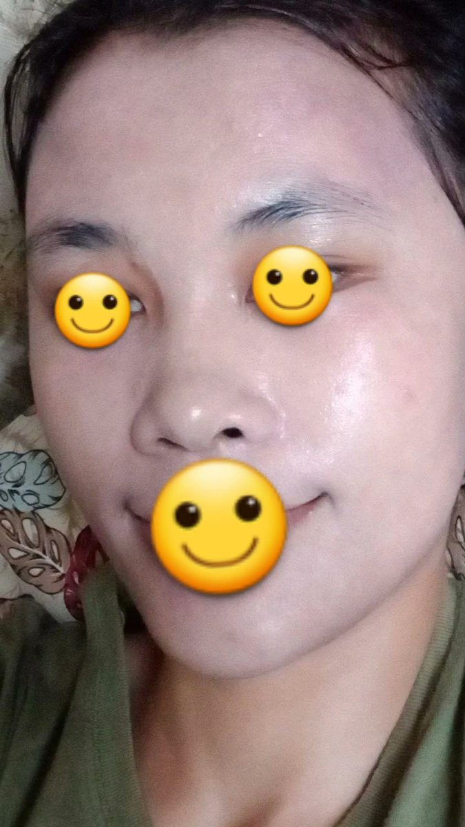 racundeta's tweet photo. AJAIBNYA tanggal 15 oktober 2022 muka gue udah membaik banget😭✋ selama 1 bulan bermasalah, tapi karena tidak kesengajaan pake produk https://t.co/i8eIwramI6 langsung sembuh. Padahal cuman 3 hari pake tapi muka udah kayak gini!!!!
PRODUK AJAIB BANGET DI MUKA GUE🙏 https://t.co/PtrEhdIVaQ