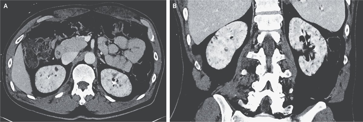 Diagnosis in this #bipolar patient? (Source: NEJM)