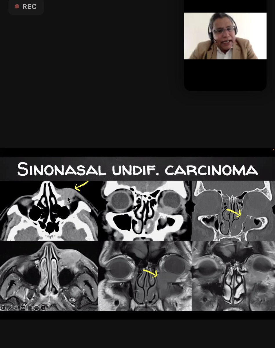 ESHNRSociety's tweet photo. A selection on lacrimal sac snd nasolacrimal duct pathology
@vassallo_edith @RamVaidhyanath @davidefarinabs @YPekcevik @AnnePeporte @jussihirvonen @SalmanQureshiDr @PTouska @ASHNRSociety
#eshnr https://t.co/9uNXNHSC3D