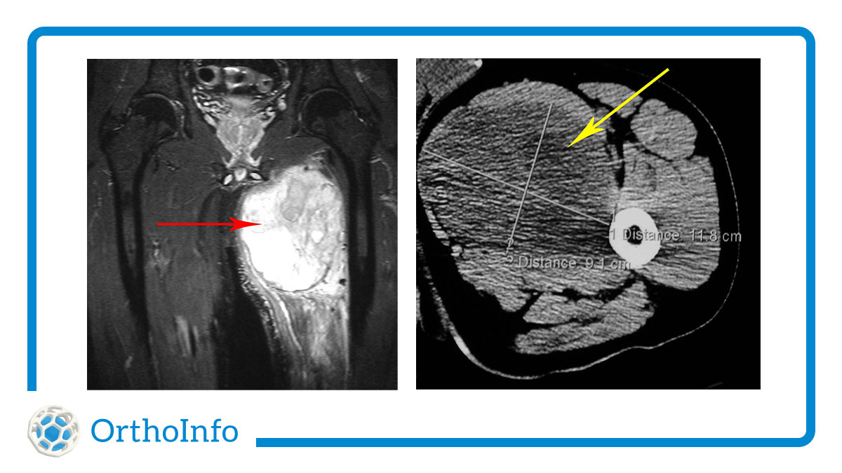 AAOS (@aaos1) on Twitter photo A #SarcomaAwarenessMonth fact: The 1st sign of #softtissuesarcoma is often a painless, slow-growing lump on the trunk or limbs. Learn other symptoms of these rare cancers at #OrthoInfo: bit.ly/3yY5SR3 #Orthotwitter <a href="/AmericanCancer/">American Cancer Society</a> <a href="/CureSarcoma/">Sarcoma Foundation of America</a> <a href="/RareDiseases/">National Organization for Rare Disorders (NORD)</a> @MSTSCares A #SarcomaAwarenessMonth fact: The 1st sign of #softtissuesarcoma is often a painless, slow-growing lump on the trunk or limbs. Learn other symptoms of these rare cancers at #OrthoInfo: bit.ly/3yY5SR3 #Orthotwitter <a href="/AmericanCancer/">American Cancer Society</a> <a href="/CureSarcoma/">Sarcoma Foundation of America</a> <a href="/RareDiseases/">National Organization for Rare Disorders (NORD)</a> @MSTSCares