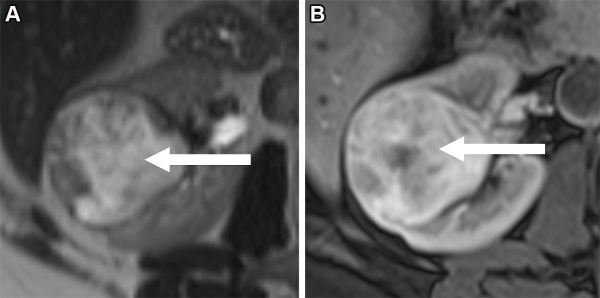 Review the case examples in this article to evaluate major and ancillary MRI features of the clear cell likelihood score (ccLS) algorithm for assigning a likelihood score to a small solid renal mass. bit.ly/46USRrp @nupedogg @DavidBallardMD @ItaniMalak @BCUSWORTH