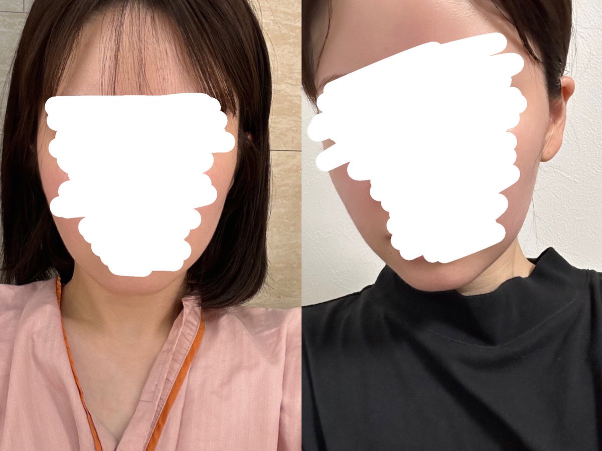 __mellchan_'s tweet photo. アーバン美容外科でKDOLリフトをして1ヶ月半が経ちました！正面もですが、横顔がかなりすっきりして本当に満足しています😊✨
@prs_urban https://t.co/GXUAW46U7J