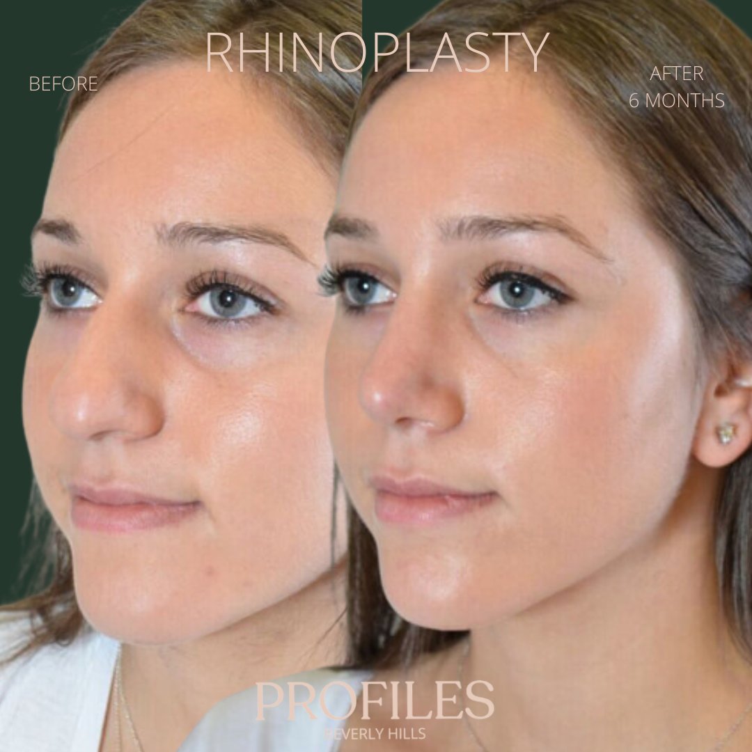 FacialPlastics's tweet photo. 📞310-276-6800
🏠 435 N Bedford Drive, PH500, Beverly Hills, 90210
👃Rhinoplasty
🗓 Before and After 6 Months
🛏 About 1 week, the cast gets taken off after 6 days

Swipe ⏩⏩⏩ for more views

A boxy, bulbous tip, nasal hump, and excessive length can allow the ... https://t.co/32Vg8prFTx