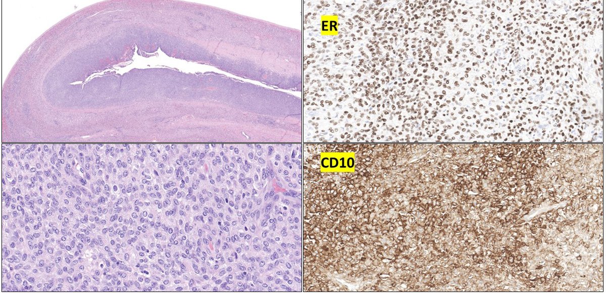 This tumor traveled a long way. From #endometrium to all the way to the #liver ! I have never seen a low grade endometrial stromal sarcoma in the liver. #endometrialstromalsarcoma #PathTwitter