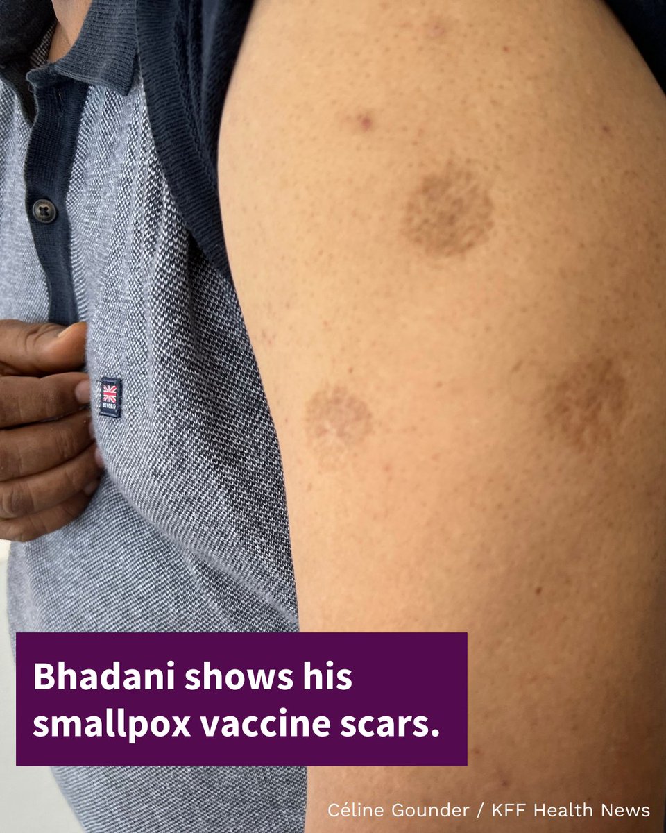KFFHealthNews's tweet image. Soon after, when eradication workers came to town, young Bhadani remembered his friend, gritted his teeth, and agreed to get the painful vaccine.

Bhadani showed @celinegounder the scars he still has from the vaccine.