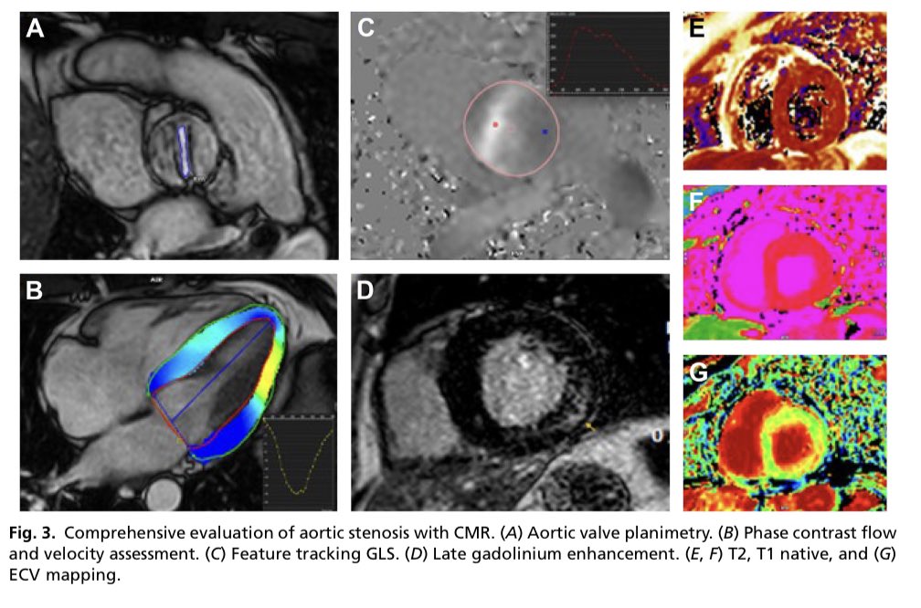 Ed_Alania's tweet photo. 🔴 Multimodality Imaging in Aortic Stenosis #CardioEd #Cardiology #CardioTwitter #echofirst #WhyCMR https://t.co/qAWq4xSKrx