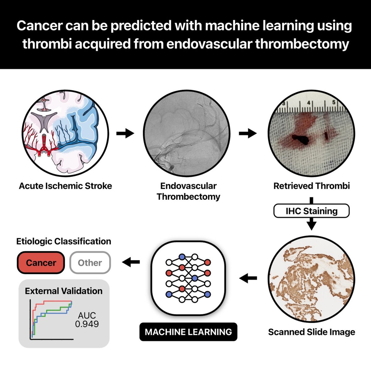 Stroke AHA/ASA (@strokeaha_asa) on Twitter photo In this study, the authors developed and validated a machine learning model for predicting an underlying cancer using platelet-stained immunohistochemical slide images of thrombi obtained during endovascular thrombectomy. #stroke #AHAJournals ahajrnls.org/44ReNSG <a href="/jnheo/">JoonNyung Heo</a> In this study, the authors developed and validated a machine learning model for predicting an underlying cancer using platelet-stained immunohistochemical slide images of thrombi obtained during endovascular thrombectomy. #stroke #AHAJournals ahajrnls.org/44ReNSG <a href="/jnheo/">JoonNyung Heo</a>