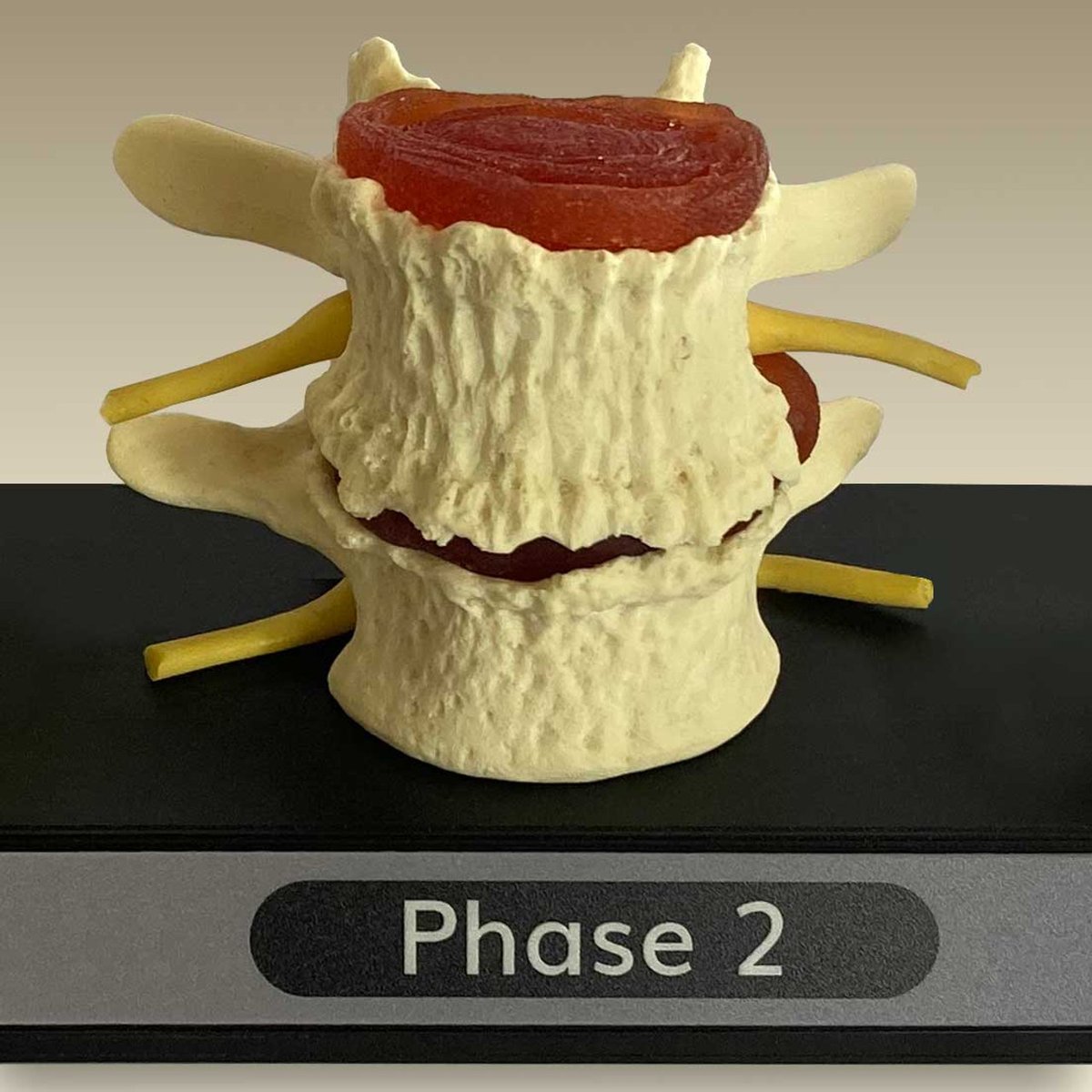 ChiroOutfitters's tweet image. Lumbar Spine Models Bring Your Report of Findings to Life
Lumbar spine X-rays jump to life with these lumbar vertebrae anatomical models. chiropracticoutfitters.com/Spine-Degenera… #spinemodel #reportoffindings #lumbardegeneration