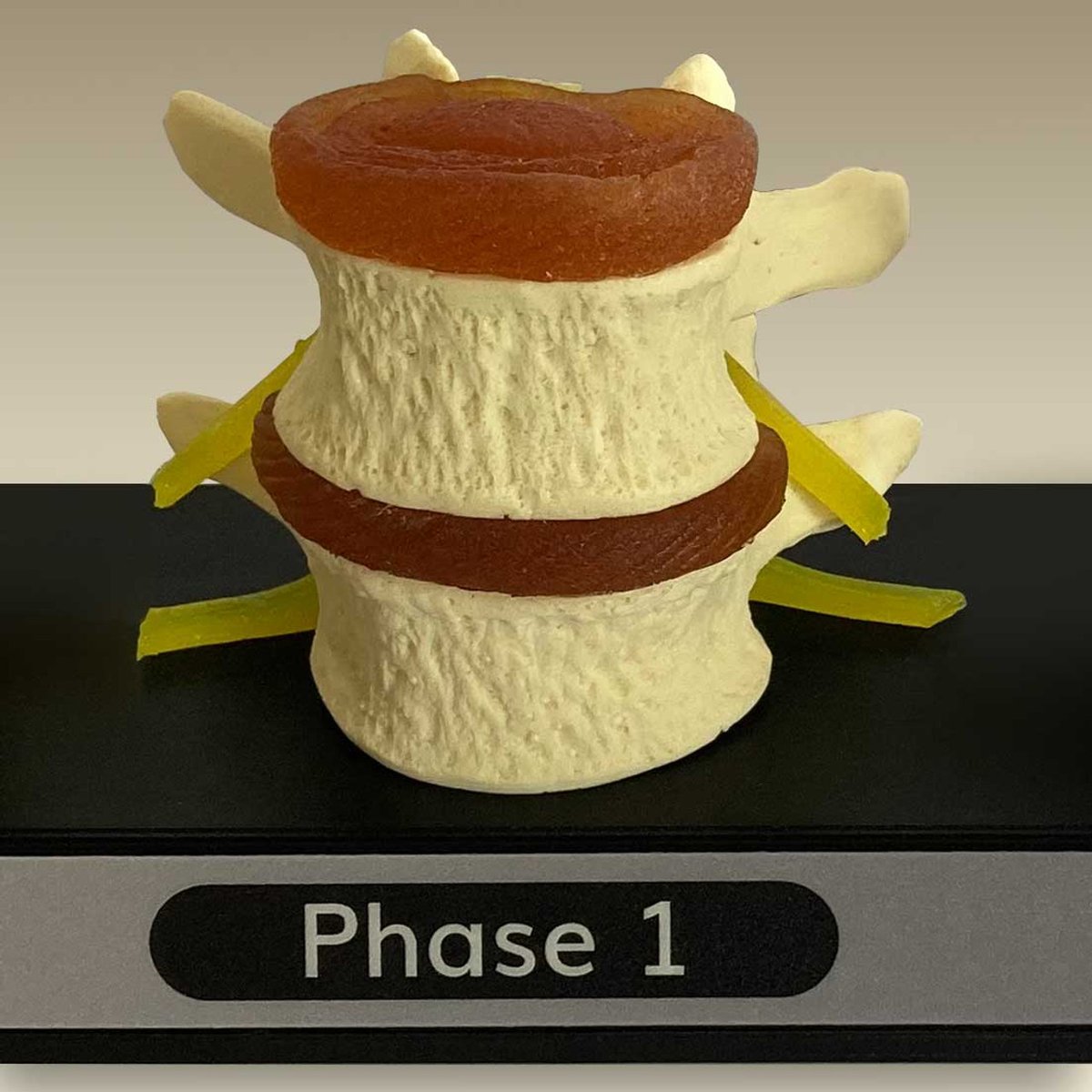 ChiroOutfitters's tweet image. Lumbar Spine Models Bring Your Report of Findings to Life
Lumbar spine X-rays jump to life with these lumbar vertebrae anatomical models. chiropracticoutfitters.com/Spine-Degenera… #spinemodel #reportoffindings #lumbardegeneration