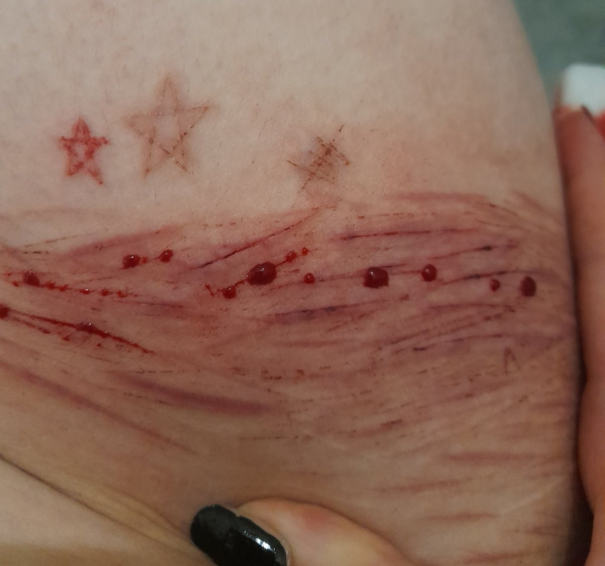 _an3m0n3's tweet photo. this area got really sensitive :/ https://t.co/WIE00fihfI