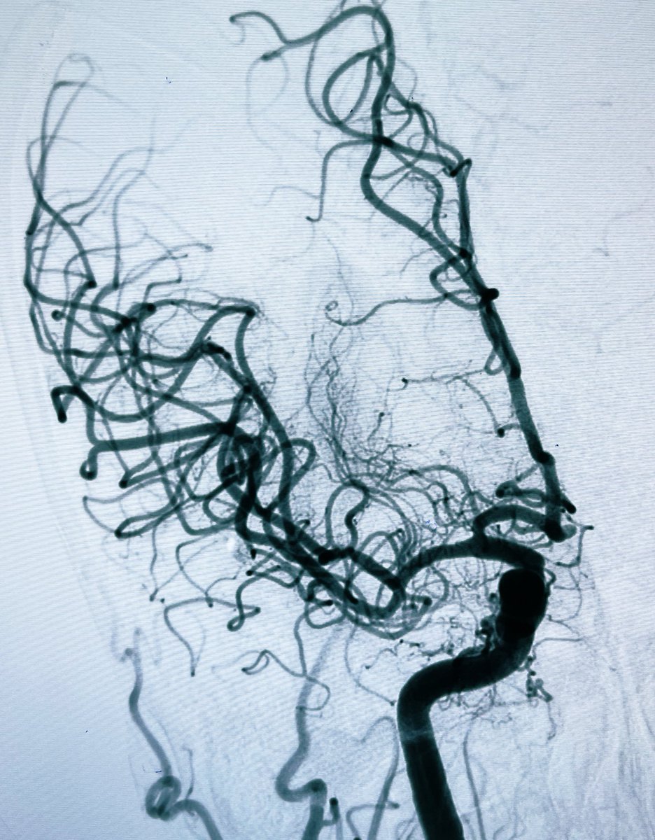 DrLe2287's tweet image. #1pass #ADAPT in 15 mins helped Pt recover on the table!