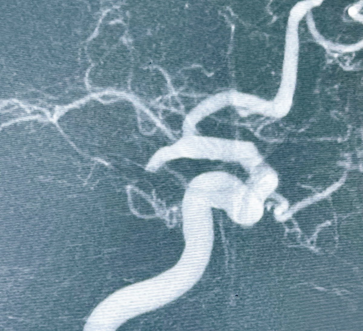 DrLe2287's tweet image. #1pass #ADAPT in 15 mins helped Pt recover on the table!