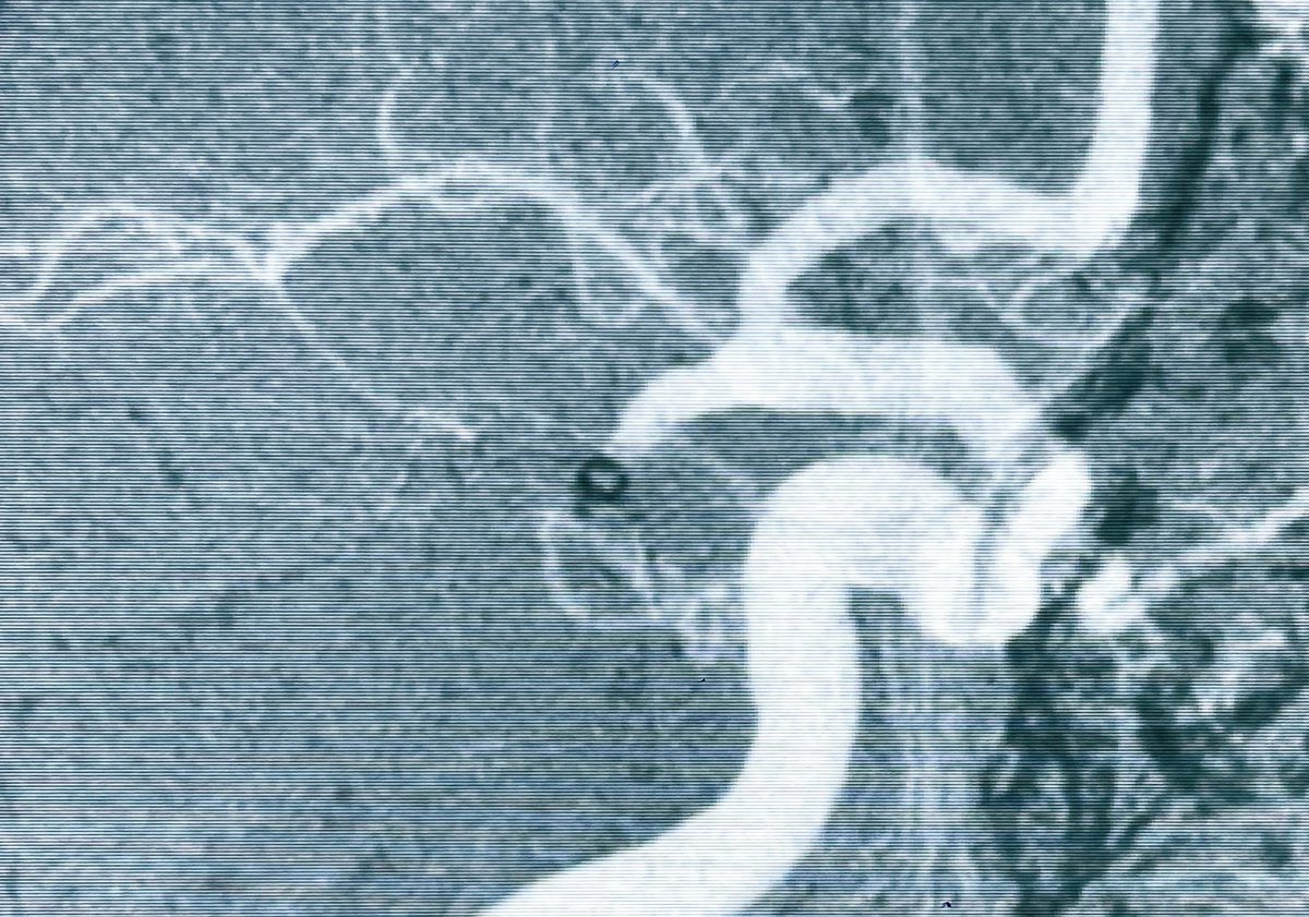 DrLe2287's tweet image. #1pass #ADAPT in 15 mins helped Pt recover on the table!
