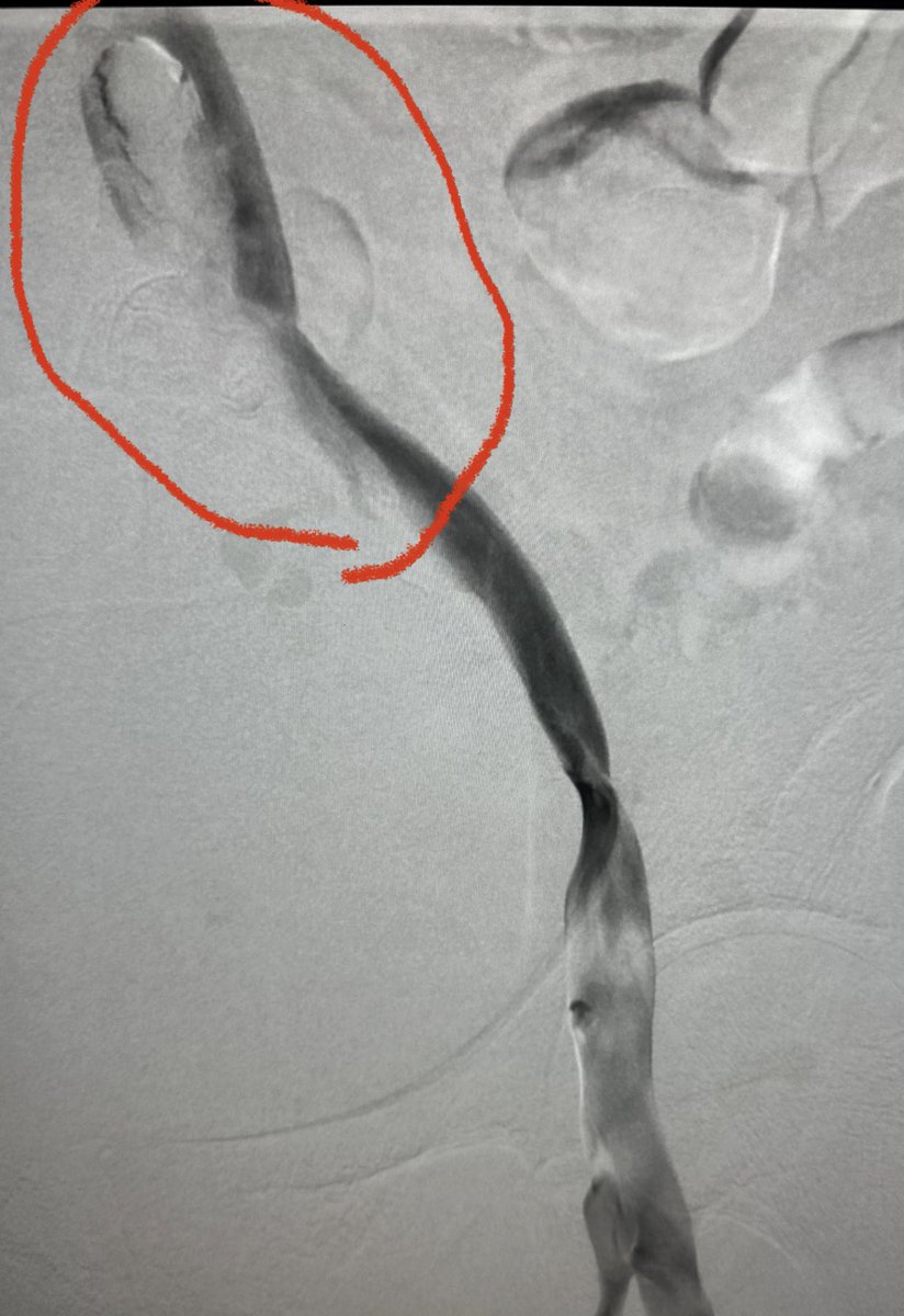 AustinBourgeois's tweet image. Thrombotic MayThurner with extensive DVT and &amp;lt; 3 days of symptoms.  You see this free floating IVC clot on venogram… what’s your management strategy of choice?

#iRad #iRadres #radres