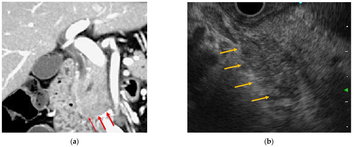HealthcareMDPI_'s tweet image. #Recommendedpaper

&quot;Clinical Characteristics of ICI-Related Pancreatitis and Cholangitis Including Radiographic and Endoscopic Findings&quot; by Ryota Nakano et al.

Read and Download for free at: mdpi.com/2227-9032/10/5…

#pancreatitis #cholangitis