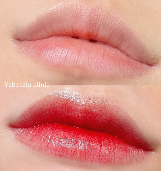 [압구정역 예뻐진의원 7월 혜택]

7월 Big event!!
반영구화장 최대 15% 할인
자세히 보기 :tinyurl.com/yc6pe2jn

1. 매끈바디보톡스 49,000원!
2. 반영구 동반 최대 15% 할인
3. 반영구 해피아워 15% 할인

※ 다이어트 너무 힘들다면? 예뻐진에서 도와줄게!!