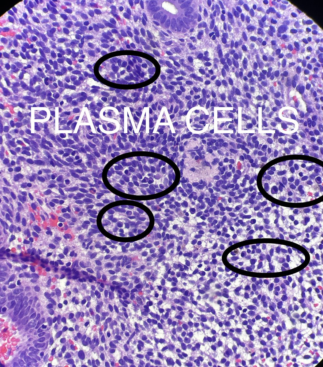 Chronic Endometritis 

Potential cause of pregnancy loss and infertility. 

Unclear etiology but some bacteria might be implicated in it. 

Diagnose: plasma cells in endometrial stroma

Treatment: antibiotics like doxycycline 

#pathtwitter #gyntwitter #obtwitter #gyntwitter