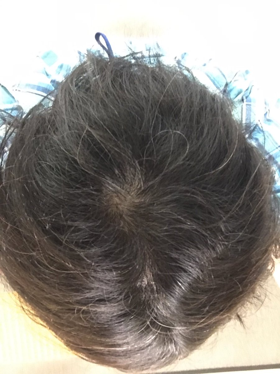 hoshimaru_aga's tweet photo. ミノタブを今のに変えて2ヶ月経過。まだ大丈夫かな？
もし薬に問題があったら3〜4ヶ月目から薄くなってくる頃。降りエレベーターで後ろに立ってる知り合いに「あれ？薄くなってね？」と言われる頃。 https://t.co/KkGEJzGopJ