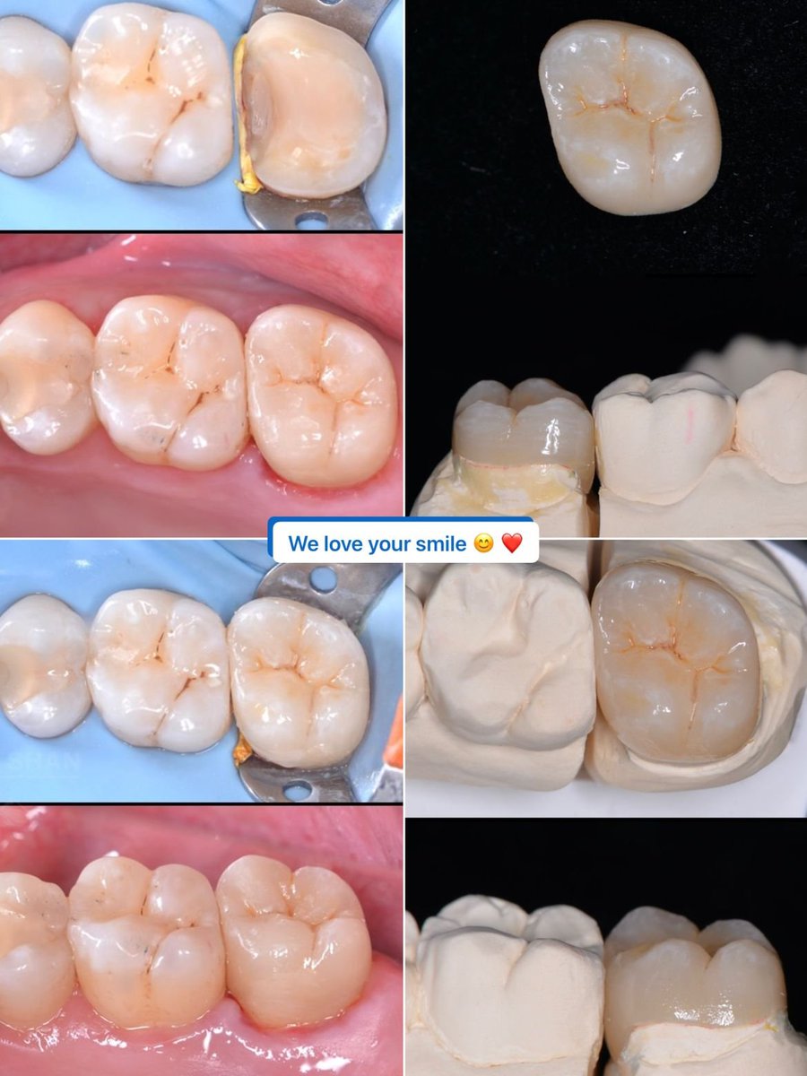 Another great result from collaboration between dentist and technicians😊☀️
#EmaxOnlay #EmaxInlay
#AestheticDental #NarutalDental
#Dentists #DentalTechnicians #IDCdental
#ChinaDental #DentalStudio
