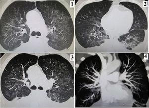 OpenRespiratory's tweet photo. 👉Today we highlight the following case report: "Bilateral Quilotóraz and COVID-19: Case Report"

🔗Link: https://t.co/UKnCh1YCaN

#OpenRespiratory #SEPAR https://t.co/UGqM8rHocS