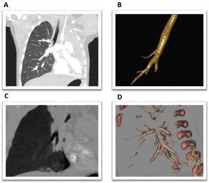 OpenRespiratory's tweet photo. 👉Hoy introducimos el siguiente artículo informativo: "Agenesia pulmonar izquierda asociada a malformaciones pulmonares derechas"

🔗Enlace: https://t.co/IfKQHKrcMS

#OpenRespiratory #SEPAR https://t.co/2ZYqxkCdxd