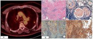 OpenRespiratory's tweet photo. 👉Hoy nos acompaña el siguiente artículo informativo: "Amilodosis pulmonar nodular: una rara entidad clínica"

🔗Enlace: https://t.co/tWhwvwxRRl

#OpenRespiratory #SEPAR https://t.co/ouhY3bVtYn