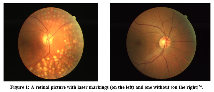 biotech_asia's tweet image. Intelligent Application of Laser for Medical Prognosis: An Instance for Laser Mark Diabetic Retinopathy
bit.ly/3Xw34WQ
#Biomedicalimageprocessing #ConvolutionalNeuralNetworks #Classificationalgorithms #DiabeticRetinopathy #Featureextraction #LaserMark #biotechnology