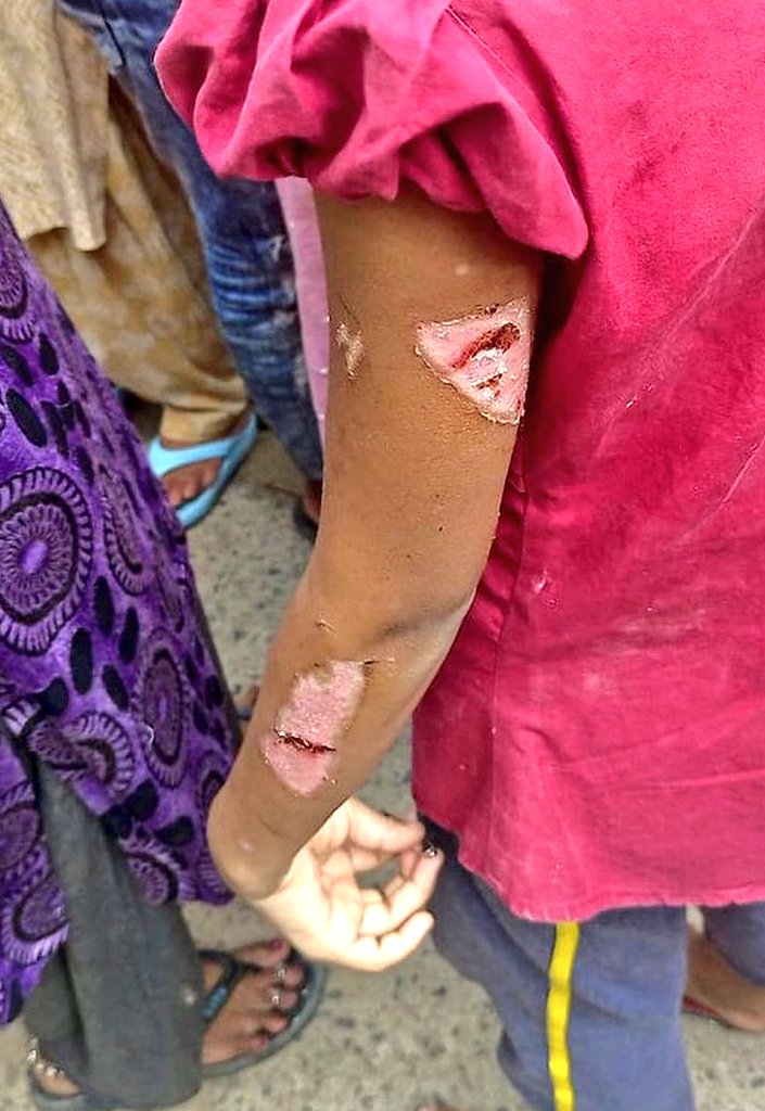 DeepikaBhardwaj's tweet photo. DWARKA : SHOCKING CHILD ABUSE

Poornima Bagchi, a pilot &amp; her husband Kaushik Bagchi have been arrested for torturing a 10 year old girl they employed as maid 2 months ago. The couple was beaten up in public after child was rescued with visible burn injuries, blood clot in eyes https://t.co/44lQLAjoLx
